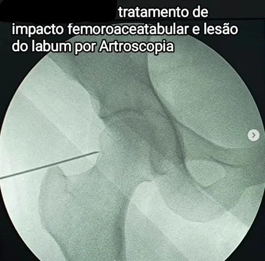 Tratamento por artroscopia