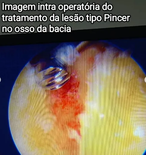 Imagem intraoperatória da lesão pincer