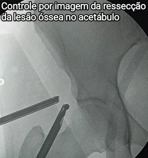 Controle por imagem da ressecção óssea