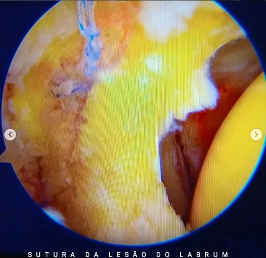 Sutura da lesão do labrum