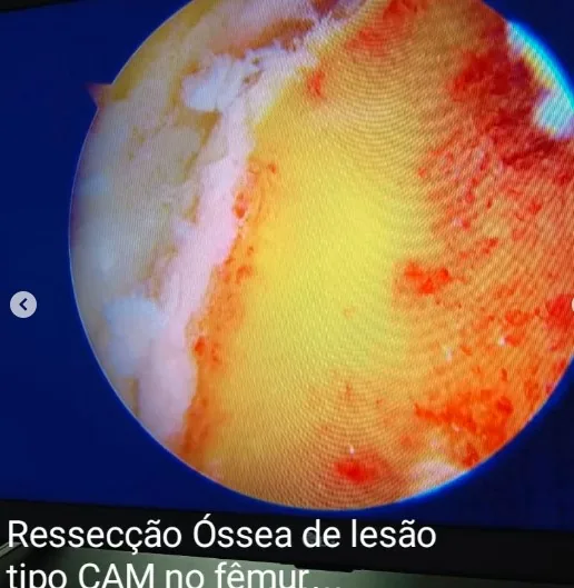 Ressecção óssea tipo CAM no fêmur