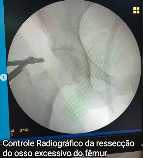 Controle radiográfico