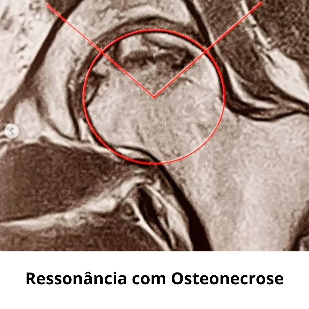 Ressonância com osteonecrose