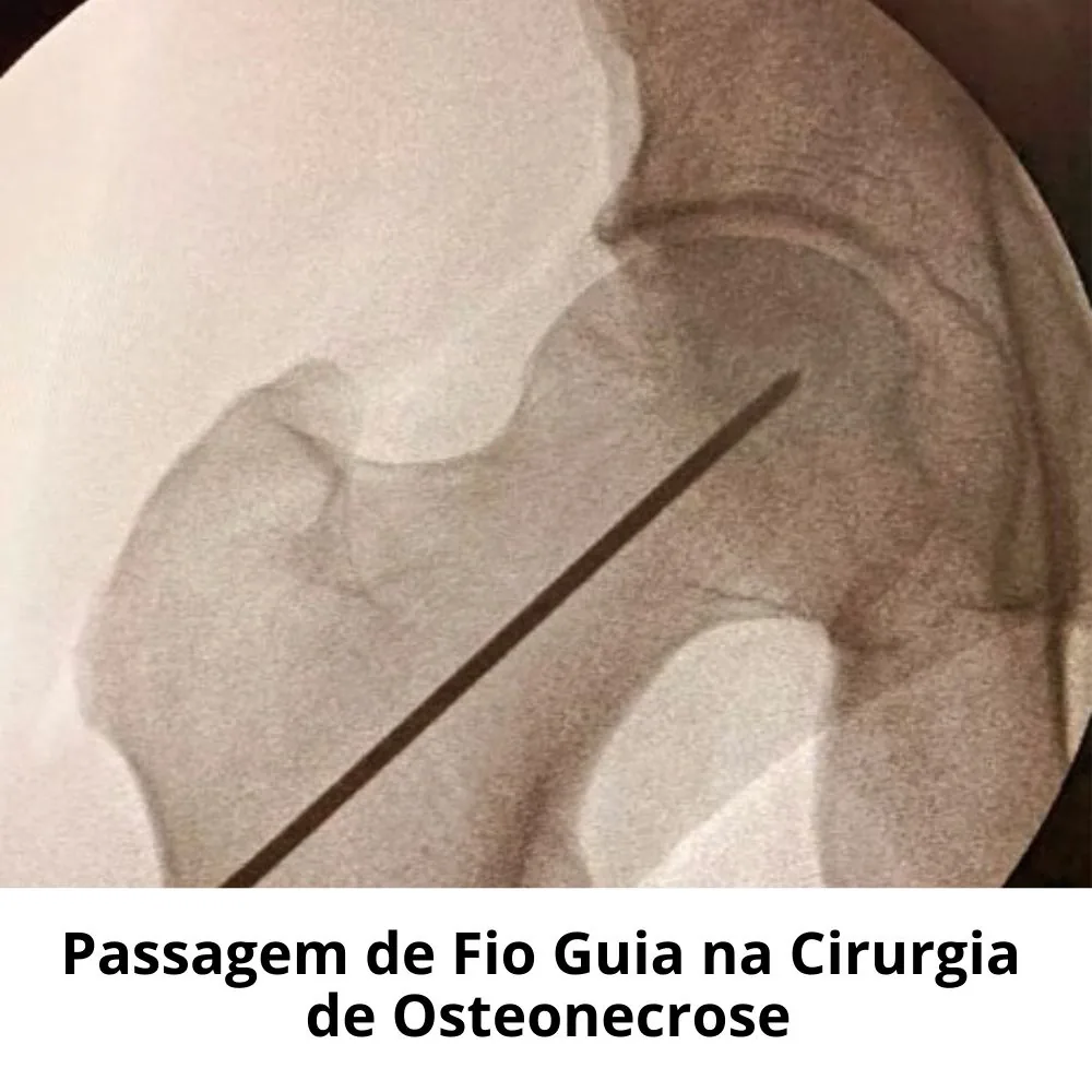 Passagem de fio guia
