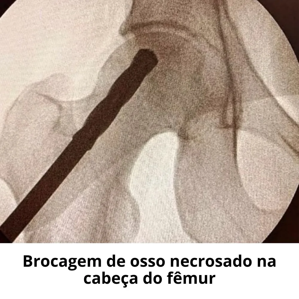 Brocagem de osso necrosado