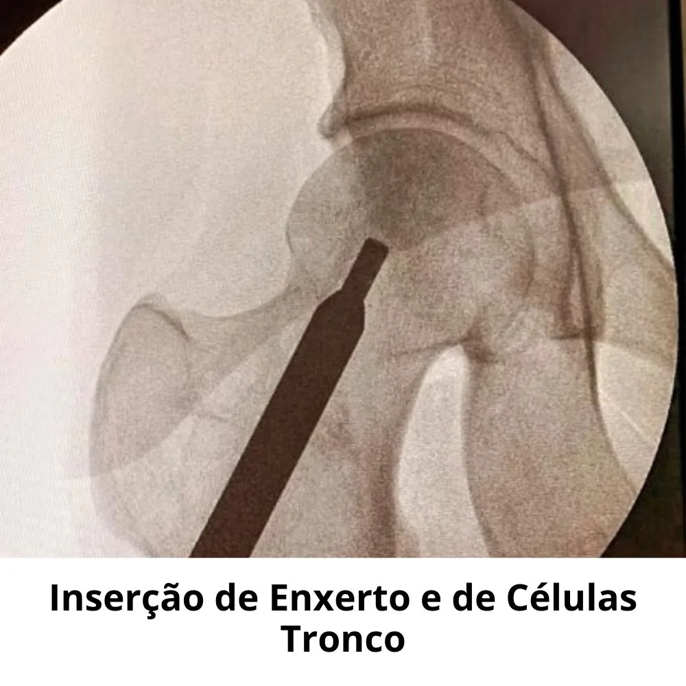 Inserção de enxerto e células tronco