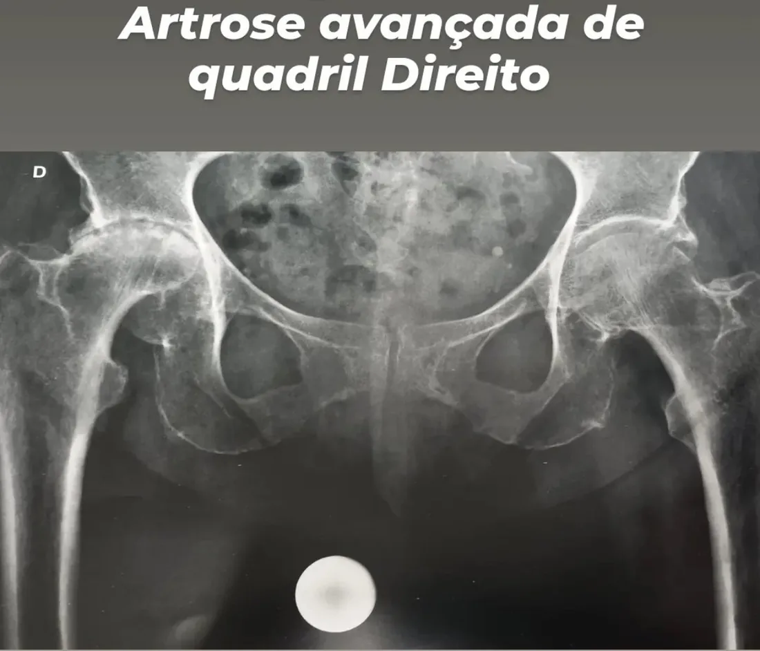 Raio X com artrose avançada do quadril