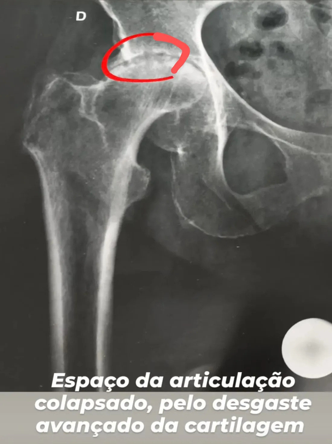 Espaço da articulação colapsado