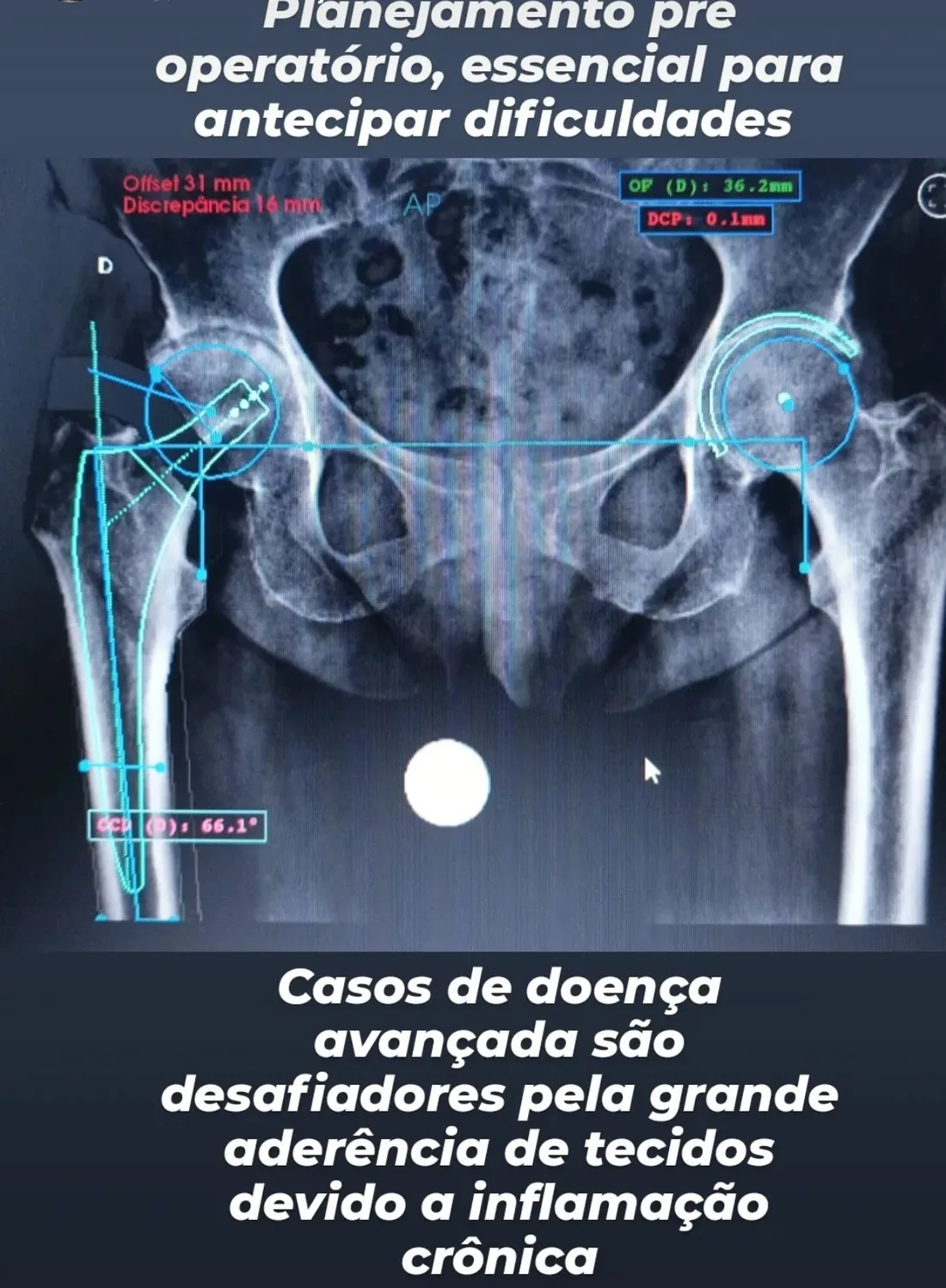 Planejamento pré-operatório