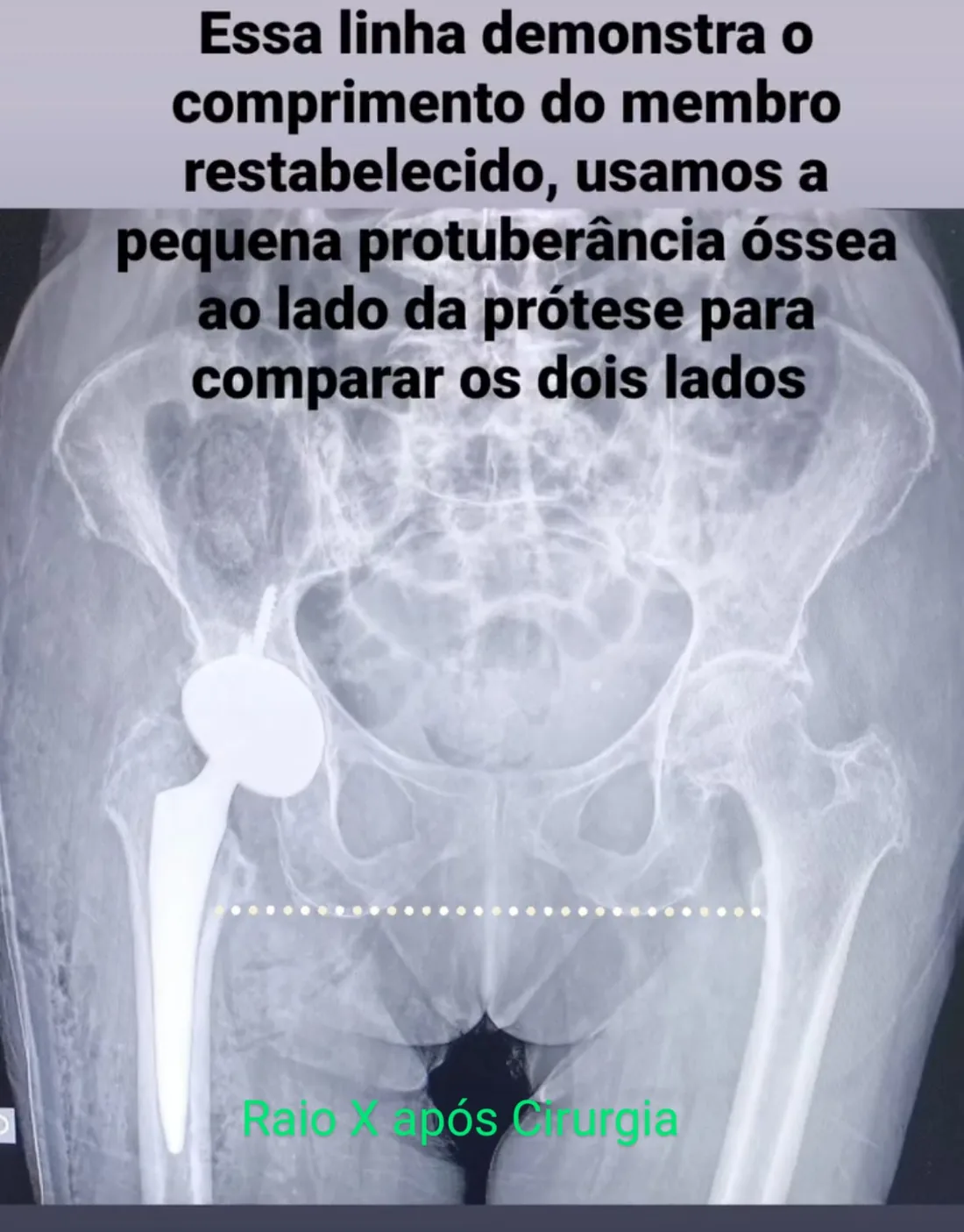 Raio X após prótese de quadril