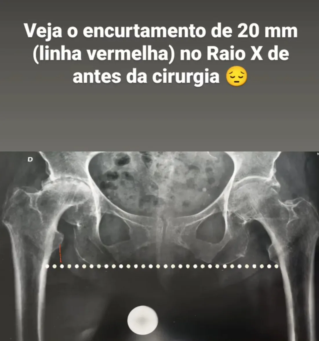 Encurtamento antes da cirurgia