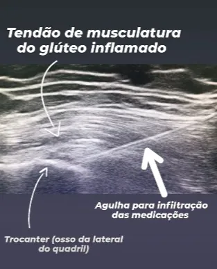 Infiltração em tendão do glúteo inflamado