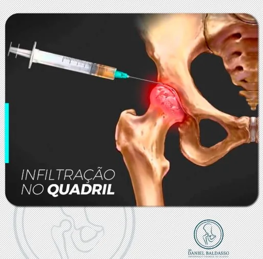 Infiltração no quadril