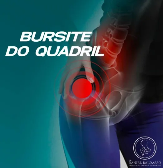 Bursite do quadril