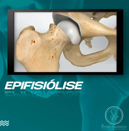 Epifisiólise