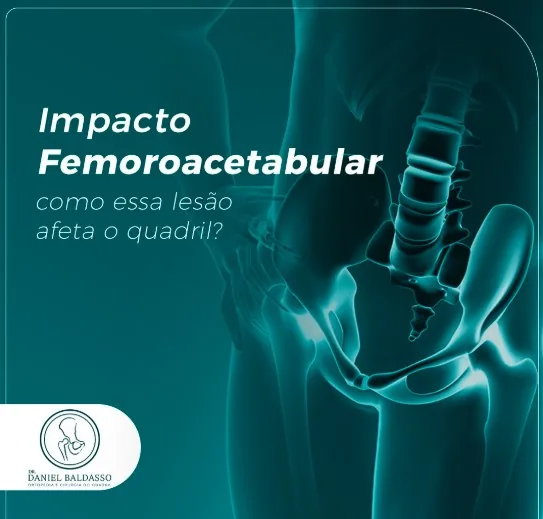 Impacto femoroacetabular