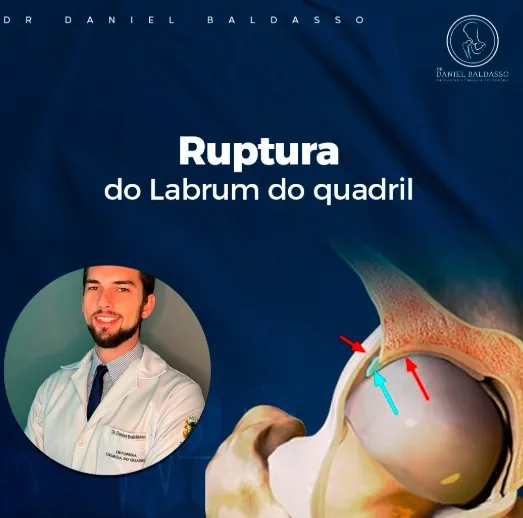 Lesão do labrum