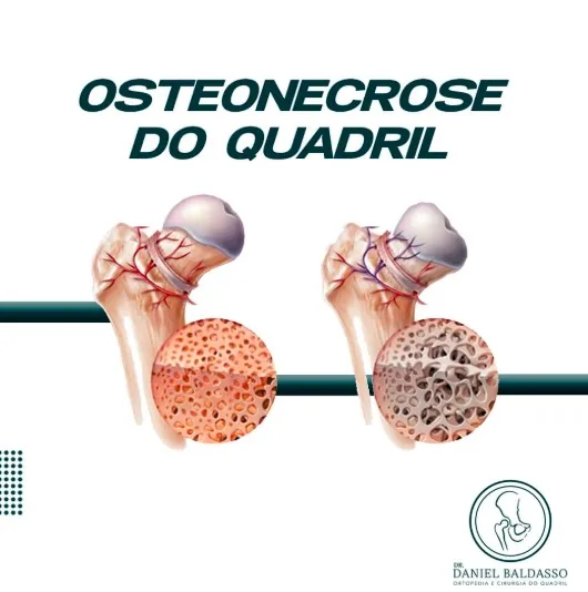 Osteonecrose do quadril