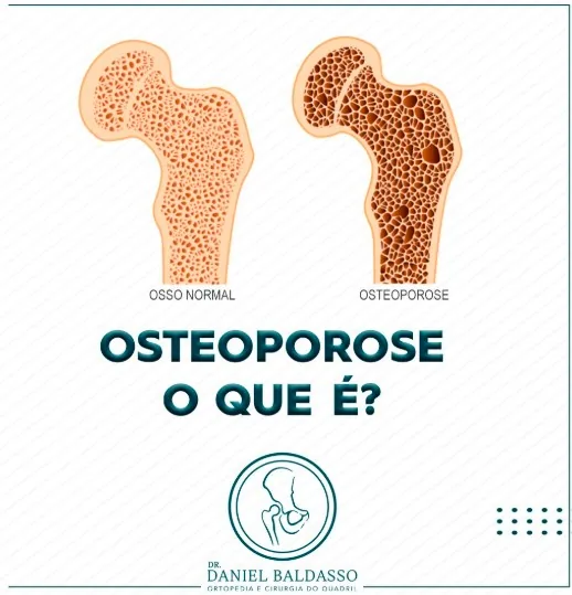 Osteoporose